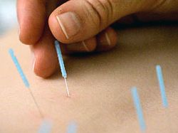 Acupuntura ayuda a aliviar dolores menstruales