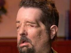 Presentan a hombre que recibió trasplante de cara