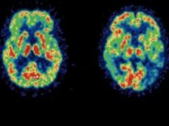 Revelan datos que ayudaran a comprender el Alzheimer