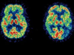 Revelan datos que ayudaran a comprender el Alzheimer