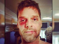 Ricky Martin mostró foto de rostro fuertemente golpeado Ricky Martin mostró foto de rostro fuertemente golpeado