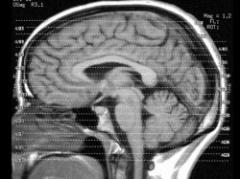 Ciencia podría borrar recuerdos de los seres humanos