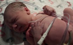 Leucemia: células madre del cordón umbilical pueden ayudar