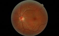 Científicos "imprimen" células oculares para reparar retina