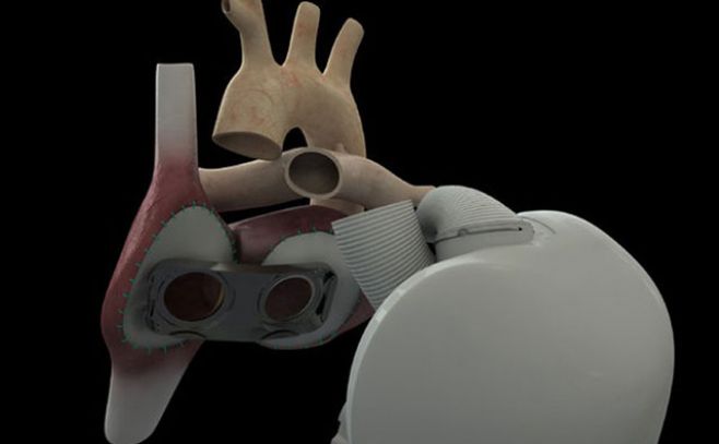 Francia: Trasplantan un corazón artificial con tejidos biológicos