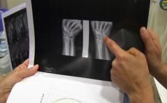 Científicos reconstruyen huesos dañados con grasa corporal