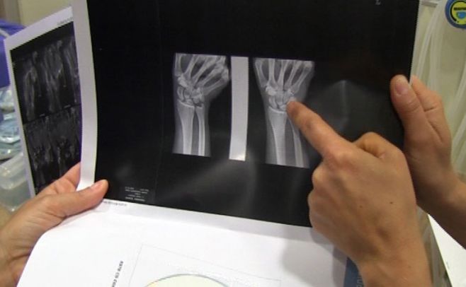 Científicos reconstruyen huesos dañados con grasa corporal