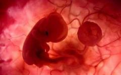 Anciana de 84 años lleva dentro un feto desde hace 44 años