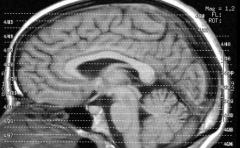 Experiencia cercana a la muerte se da por anomalía cerebral