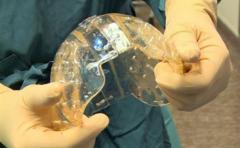 Implantan un cráneo entero hecho con una impresora 3D