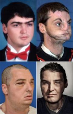 La fascinante historia del transplantado de cara