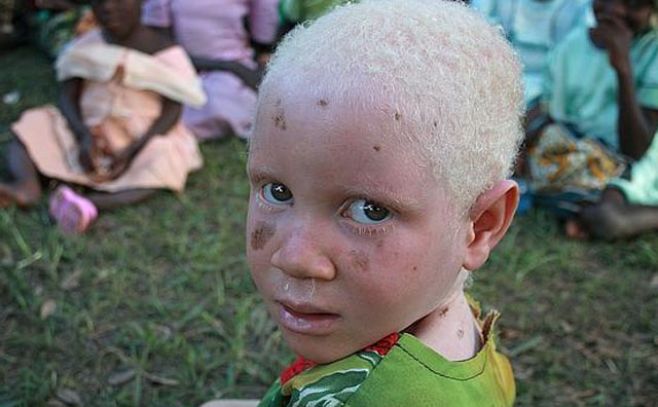 Albinos en Tanzania: amenazados y deportados Albinos en Tanzania: amenazados y deportados