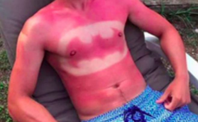 "Sunburn Art", la peligrosa moda de tatuarse con el sol. Redes sociales