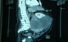 Extirparán tumor de 15 kilos a una mujer