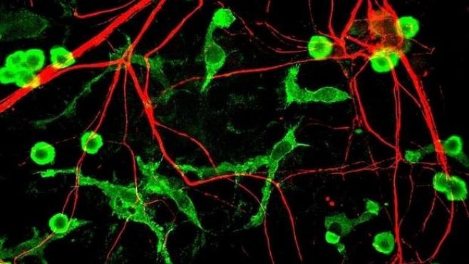 Epilepsia no permite "limpieza" de neuronas muertas