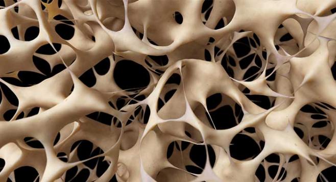 Positivo acceso a diagnóstico precoz para prevenir la osteoporosis