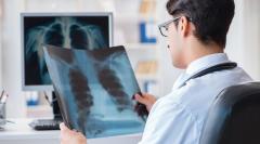 El 25 % de los casos de cáncer de pulmón desarrollan metástasis cerebral